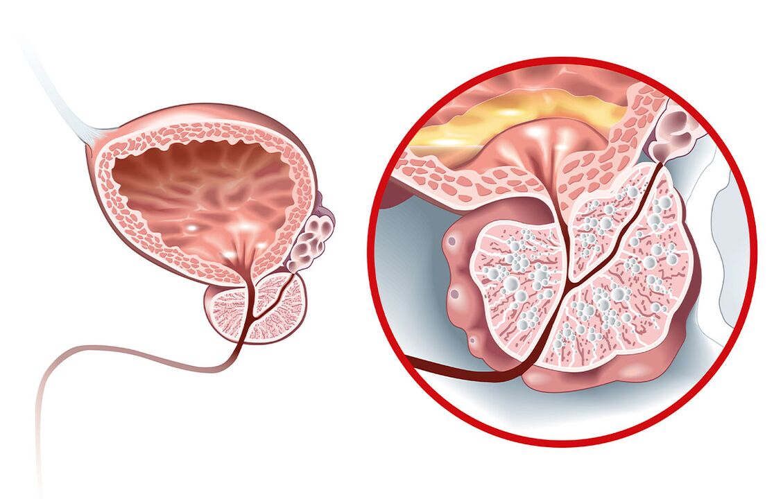 Was passiert mit der Prostata bei Adenom und Prostatitis 